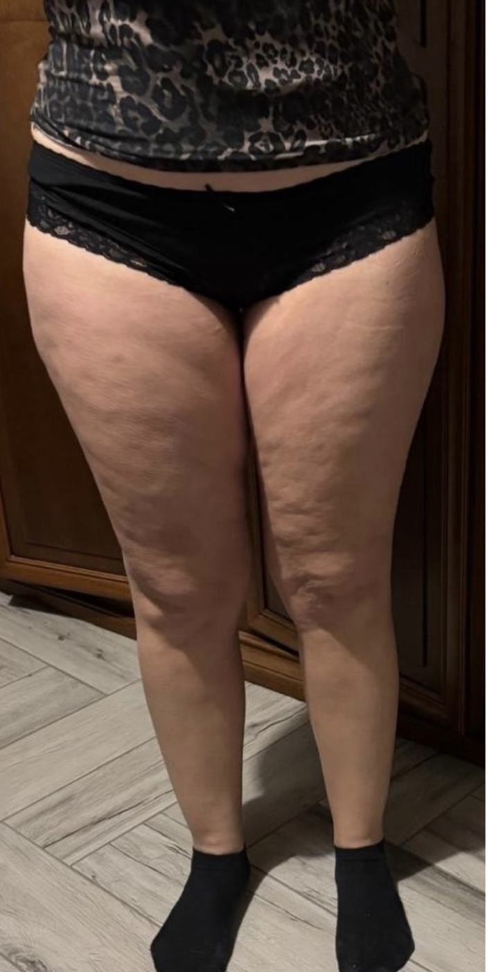 Gambe di Jacqueline prima del percorso anti-lipedema