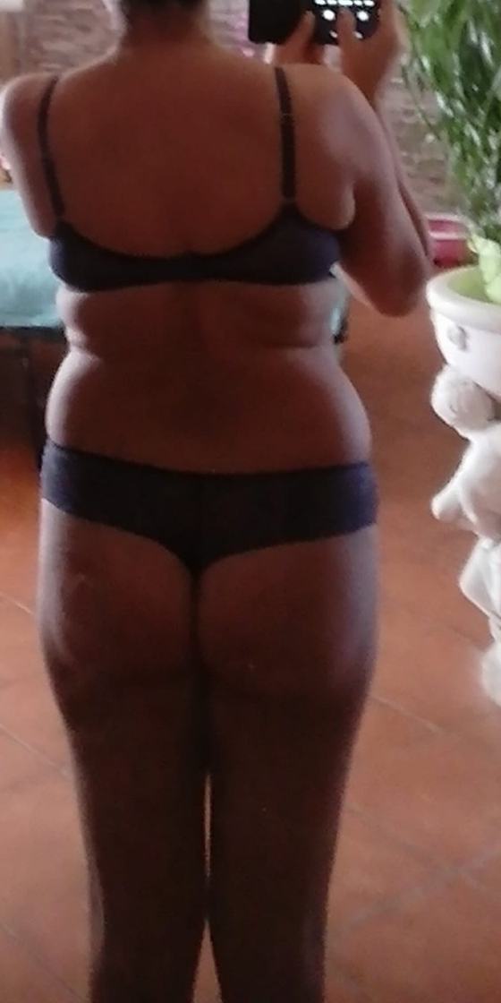 Gambe di Roberta prima del percorso anti-lipedema